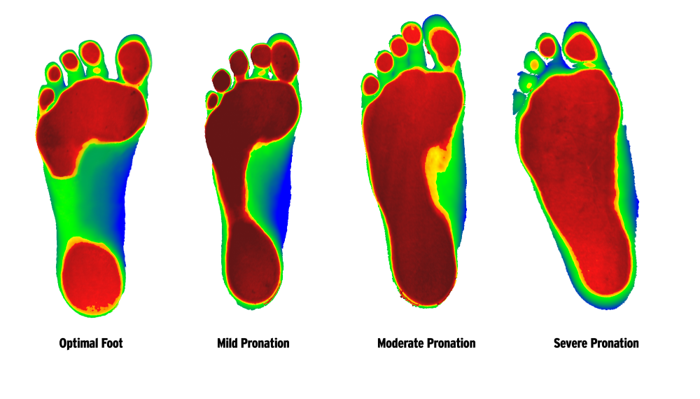 Cusdtom Foot ORthotics